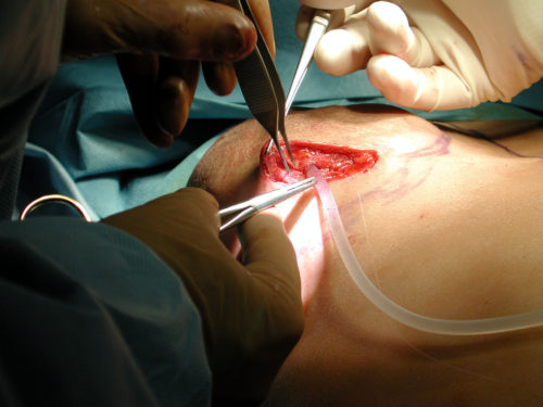 Breast Augmentation surgery close up